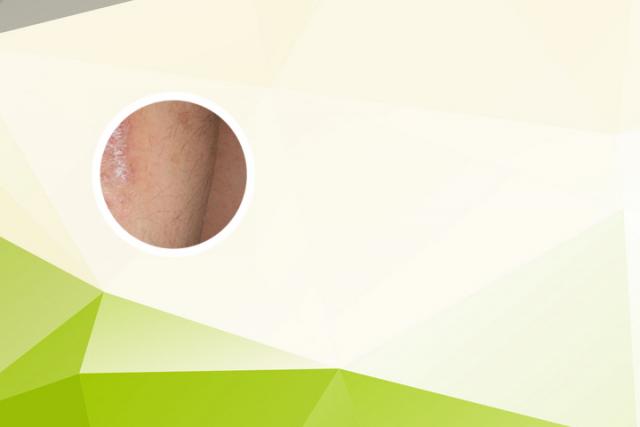 成都治银屑病哪里好