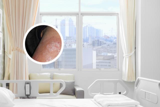 巴中专治牛皮癣医院