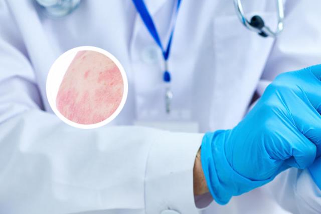 眉山哪里医院看牛皮癣