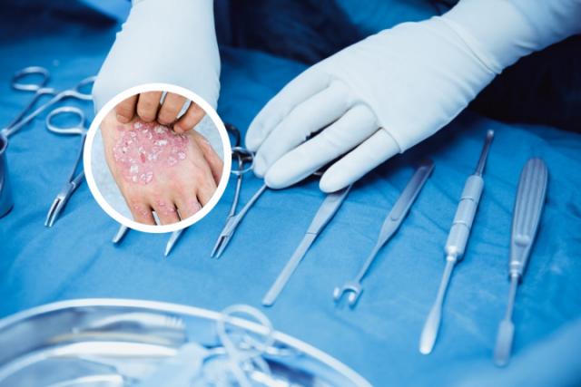 广元牛皮癣专科医院